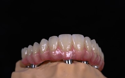 Предимства на метода All-on-4: когато четири импланта връщат цялата усмивка